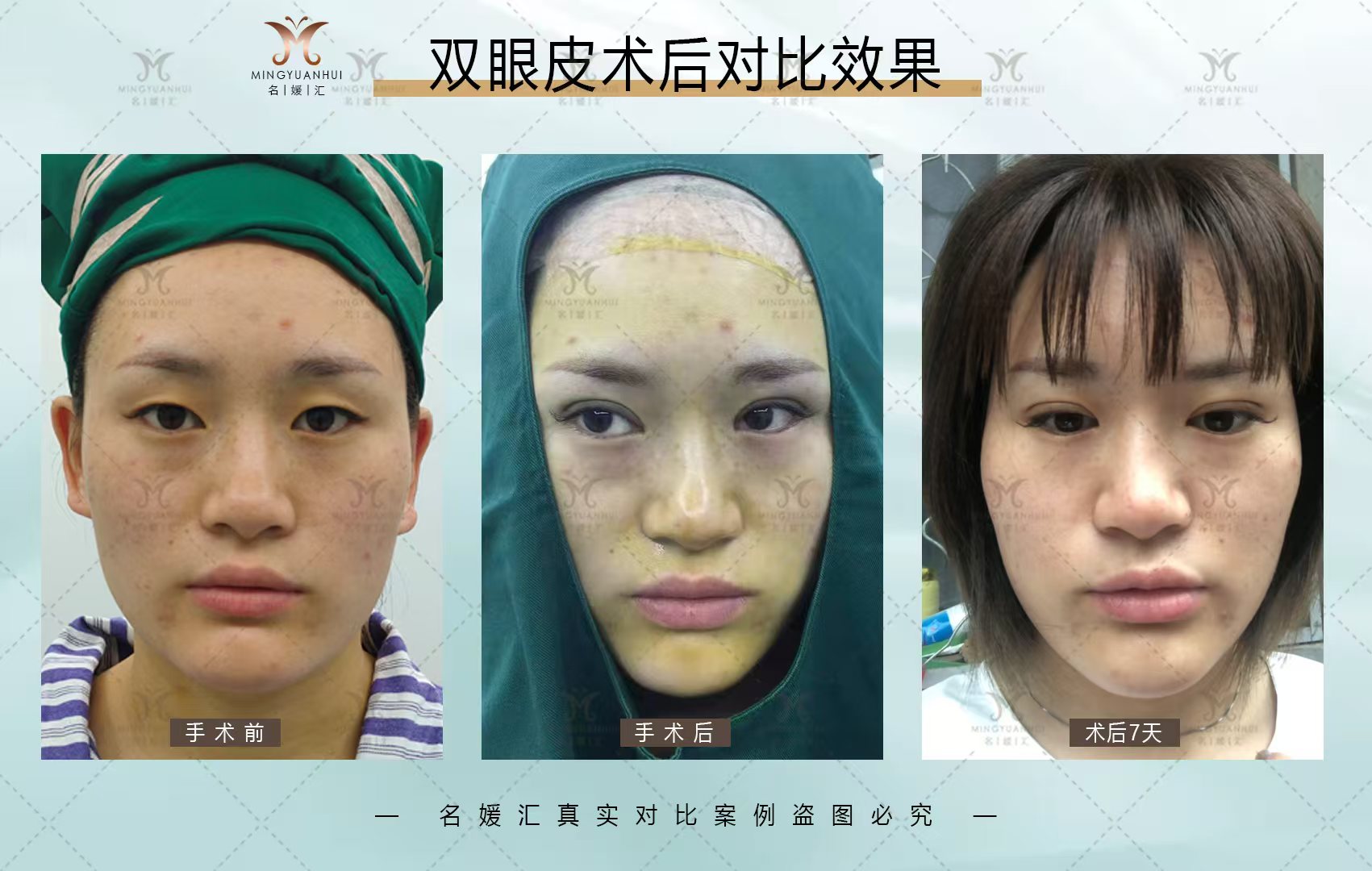 双眼皮术后对比效果
