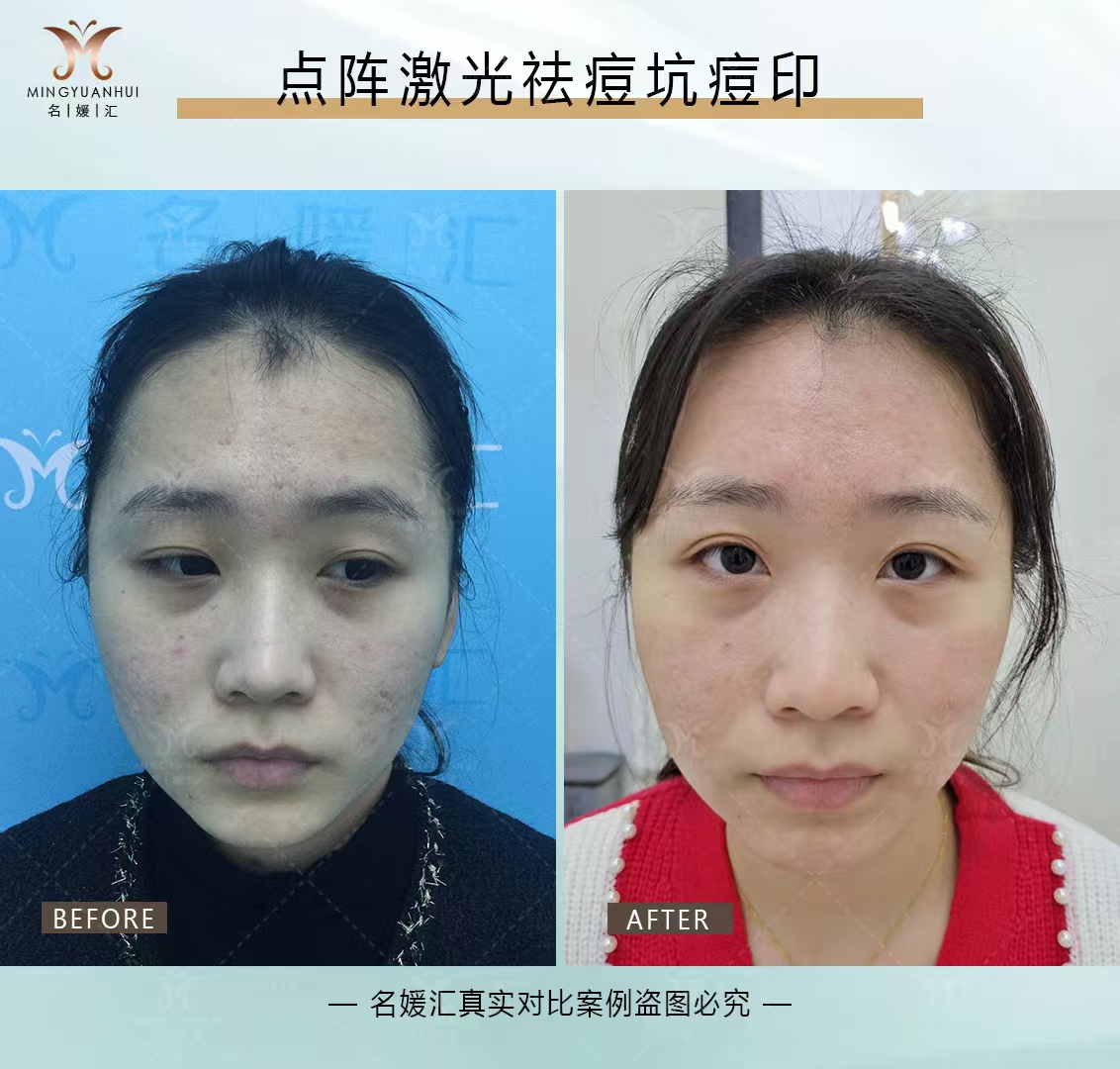 点阵激光祛痘坑痘印效果
