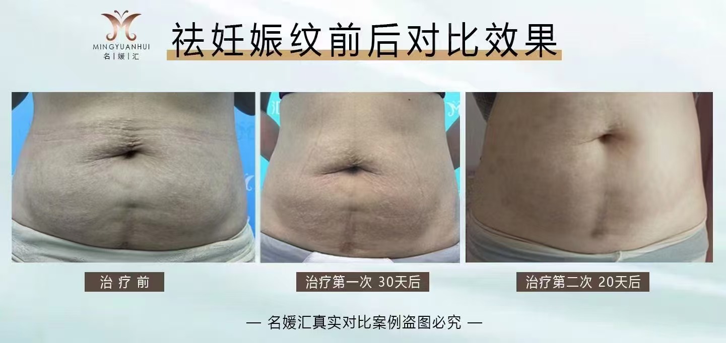 祛妊娠纹前后对比效果